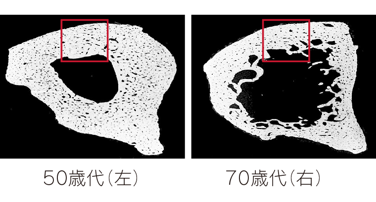 健康寿命のカギ 骨粗しょう症 あなたも注意 リビング滋賀 女性のための総合生活情報紙