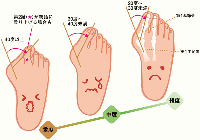 外反母趾の重症度